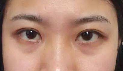黑眼圈